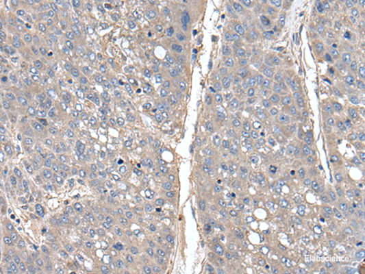Immunohistochemistry of paraffin-embedded Human liver cancer tissue  using THAP10 Polyclonal Antibody at dilution of 1:40(×200)