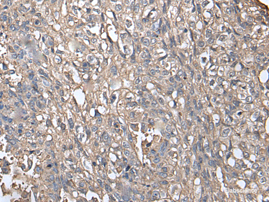 Immunohistochemistry of paraffin-embedded Human lung cancer tissue  using NDUFB5 Polyclonal Antibody at dilution of 1:45(×200)