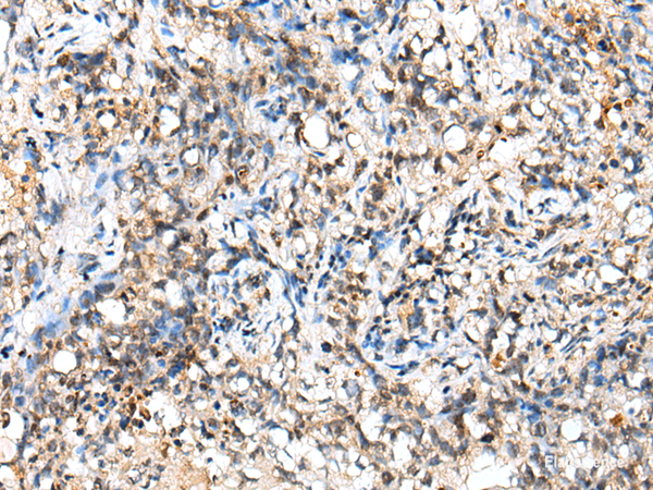 Immunohistochemistry of paraffin-embedded Human lung cancer tissue  using NUDT18 Polyclonal Antibody at dilution of 1:40(×200)