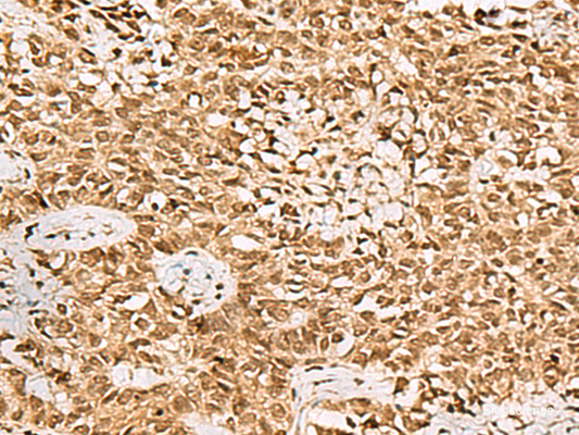 Immunohistochemistry of paraffin-embedded Human ovarian cancer tissue  using LRRC2 Polyclonal Antibody at dilution of 1:70(×200)