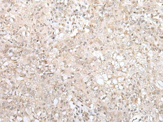 Immunohistochemistry of paraffin-embedded Human esophagus cancer tissue  using ZNF263 Polyclonal Antibody at dilution of 1:40(×200)