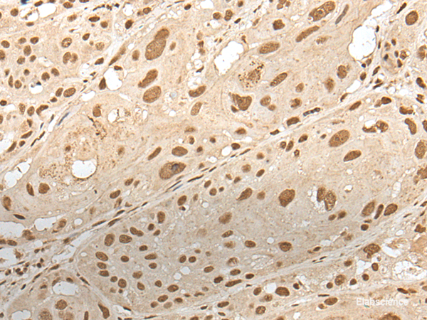 Immunohistochemistry of paraffin-embedded Human esophagus cancer tissue  using ZNF274 Polyclonal Antibody at dilution of 1:35(×200)