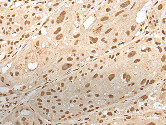 Immunohistochemistry of paraffin-embedded Human esophagus cancer tissue  using ZNF274 Polyclonal Antibody at dilution of 1:35(×200)
