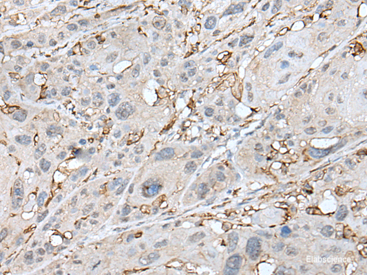 Immunohistochemistry of paraffin-embedded Human esophagus cancer tissue  using CD14 Polyclonal Antibody at dilution of 1:40(×200)