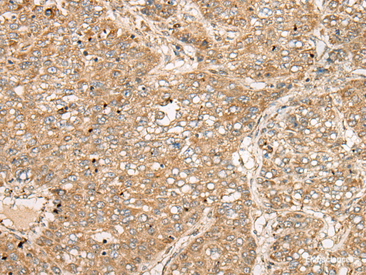 Immunohistochemistry of paraffin-embedded Human liver cancer tissue  using TDGF1 Polyclonal Antibody at dilution of 1:50(×200)