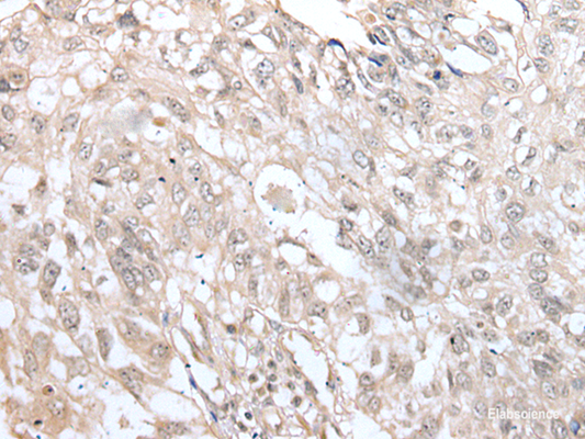 Immunohistochemistry of paraffin-embedded Human lung cancer tissue  using VRK3 Polyclonal Antibody at dilution of 1:45(×200)