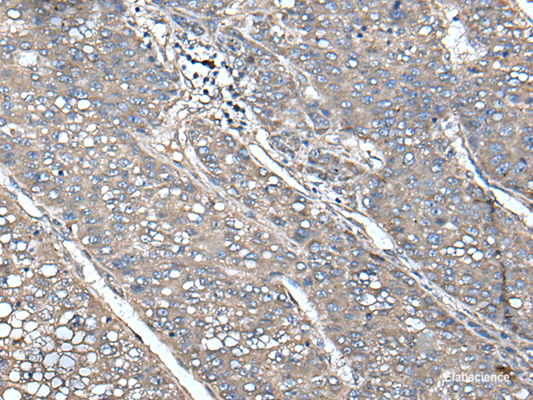 Immunohistochemistry of paraffin-embedded Human liver cancer tissue  using UNC13B Polyclonal Antibody at dilution of 1:85(×200)