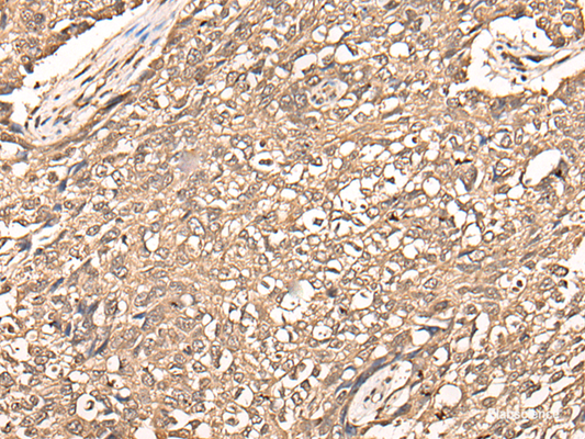 Immunohistochemistry of paraffin-embedded Human lung cancer tissue  using USP21 Polyclonal Antibody at dilution of 1:50(×200)
