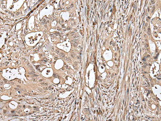 Immunohistochemistry of paraffin-embedded Human colorectal cancer tissue  using UTP3 Polyclonal Antibody at dilution of 1:50(×200)