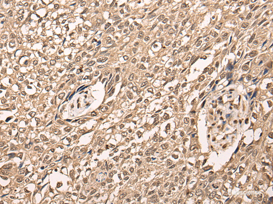 Immunohistochemistry of paraffin-embedded Human lung cancer tissue  using ATF7 Polyclonal Antibody at dilution of 1:40(×200)