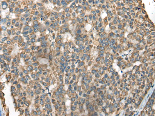 Immunohistochemistry of paraffin-embedded Human liver cancer tissue  using BLNK Polyclonal Antibody at dilution of 1:65(×200)