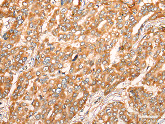 Immunohistochemistry of paraffin-embedded Human liver cancer tissue  using ZMYND10 Polyclonal Antibody at dilution of 1:35(×200)