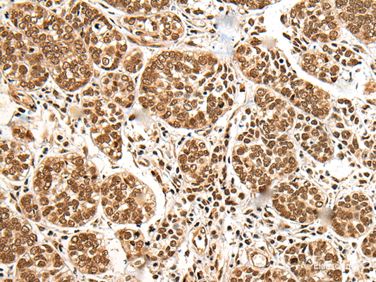 Immunohistochemistry of paraffin-embedded Human esophagus cancer tissue  using BRSK1 Polyclonal Antibody at dilution of 1:95(×200)