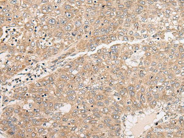 Immunohistochemistry of paraffin-embedded Human liver cancer tissue  using C1orf101 Polyclonal Antibody at dilution of 1:45(×200)