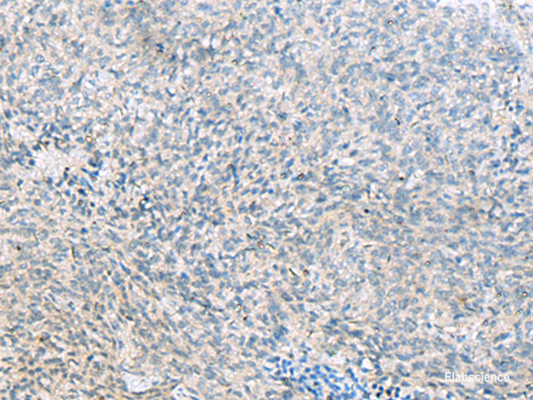 Immunohistochemistry of paraffin-embedded Human cervical cancer tissue  using C1orf112 Polyclonal Antibody at dilution of 1:55(×200)