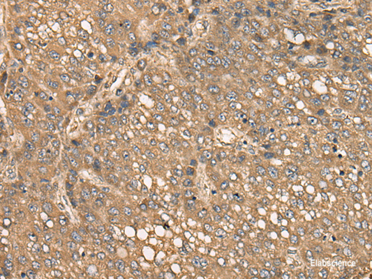 Immunohistochemistry of paraffin-embedded Human liver cancer tissue  using C4BPB Polyclonal Antibody at dilution of 1:35(×200)