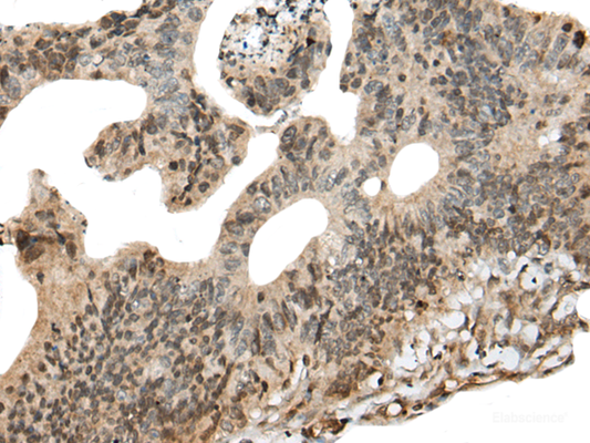 Immunohistochemistry of paraffin-embedded Human colorectal cancer tissue  using CALML5 Polyclonal Antibody at dilution of 1:90(×200)