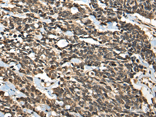 Immunohistochemistry of paraffin-embedded Human lung cancer tissue  using MICU1 Polyclonal Antibody at dilution of 1:35(×200)