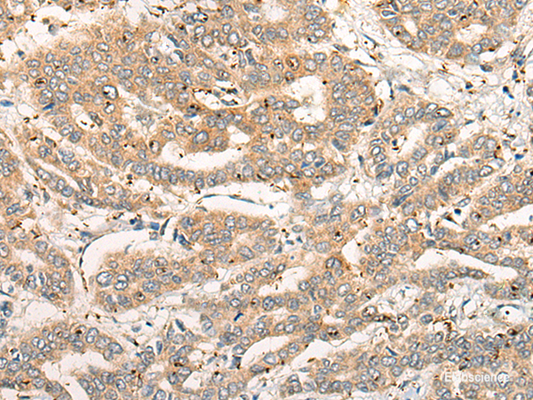 Immunohistochemistry of paraffin-embedded Human liver cancer tissue  using CPNE4 Polyclonal Antibody at dilution of 1:40(×200)