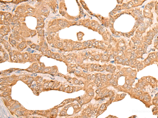 Immunohistochemistry of paraffin-embedded Human thyroid cancer tissue  using CUTA Polyclonal Antibody at dilution of 1:45(×200)