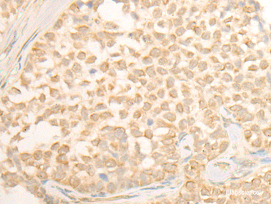 Immunohistochemistry of paraffin-embedded Human ovarian cancer tissue  using CYP4X1 Polyclonal Antibody at dilution of 1:40(×200)