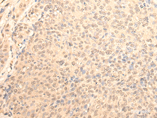 Immunohistochemistry of paraffin-embedded Human cervical cancer tissue  using DAZ1 Polyclonal Antibody at dilution of 1:70(×200)