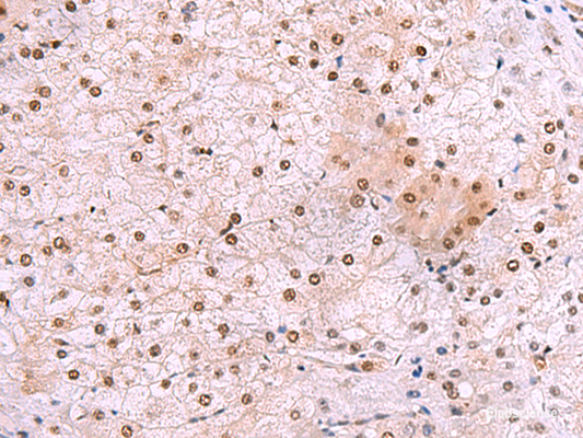 Immunohistochemistry of paraffin-embedded Human liver cancer tissue  using DDI2 Polyclonal Antibody at dilution of 1:50(×200)