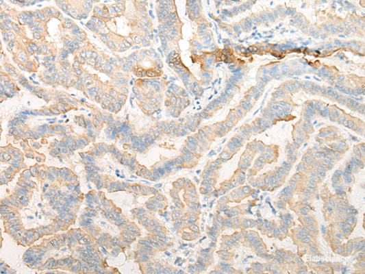 Immunohistochemistry of paraffin-embedded Human thyroid cancer tissue  using CELA3A Polyclonal Antibody at dilution of 1:25(×200)
