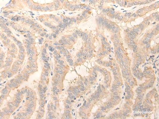 Immunohistochemistry of paraffin-embedded Human thyroid cancer tissue  using ERP27 Polyclonal Antibody at dilution of 1:25(×200)