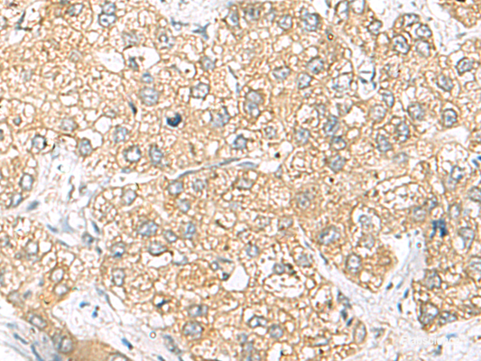 Immunohistochemistry of paraffin-embedded Human liver cancer tissue  using SH3GL2 Polyclonal Antibody at dilution of 1:45(×200)