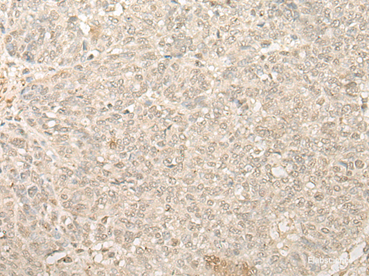 Immunohistochemistry of paraffin-embedded Human ovarian cancer tissue  using FYTTD1 Polyclonal Antibody at dilution of 1:25(×200)