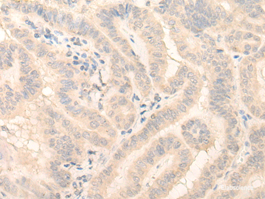 Immunohistochemistry of paraffin-embedded Human thyroid cancer tissue  using HMBS Polyclonal Antibody at dilution of 1:25(×200)