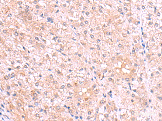 Immunohistochemistry of paraffin-embedded Human liver cancer tissue  using PISD Polyclonal Antibody at dilution of 1:80(×200)