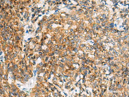 Immunohistochemistry of paraffin-embedded Human cervical cancer tissue  using TUFT1 Polyclonal Antibody at dilution of 1:120(×200)