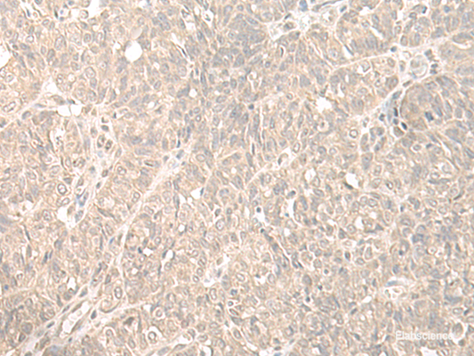 Immunohistochemistry of paraffin-embedded Human ovarian cancer tissue  using HENMT1 Polyclonal Antibody at dilution of 1:35(×200)