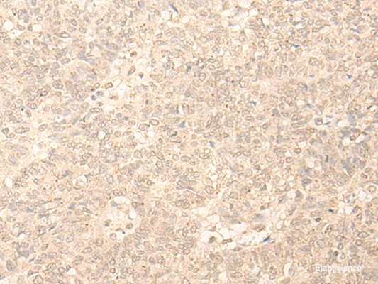 Immunohistochemistry of paraffin-embedded Human ovarian cancer tissue  using PLEKHA1 Polyclonal Antibody at dilution of 1:30(×200)