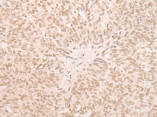 Immunohistochemistry of paraffin-embedded Human ovarian cancer tissue  using EIF4A3 Polyclonal Antibody at dilution of 1:35(×200)