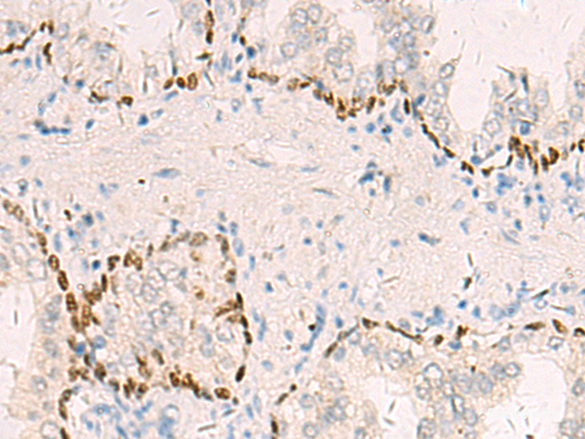 Immunohistochemistry of paraffin-embedded Human prost at e cancer tissue  using TP63 Polyclonal Antibody at dilution of 1:40(×200)