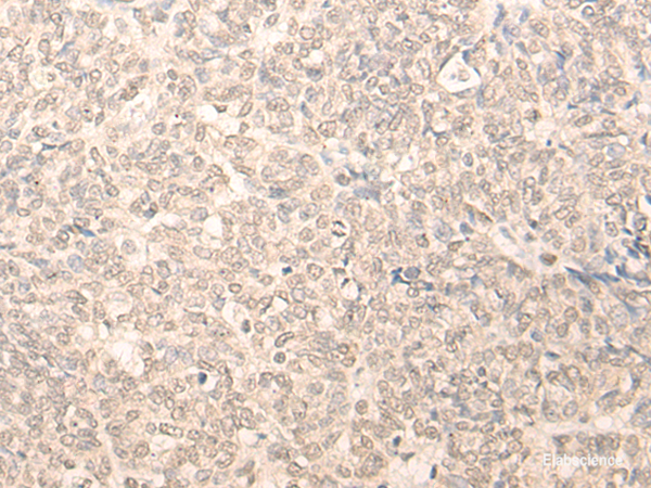 Immunohistochemistry of paraffin-embedded Human ovarian cancer tissue  using RUVBL2 Polyclonal Antibody at dilution of 1:25(×200)