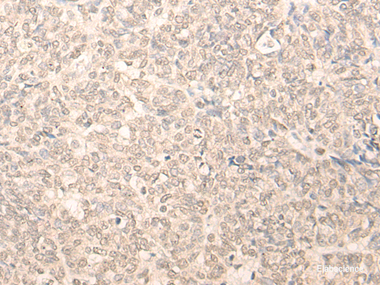 Immunohistochemistry of paraffin-embedded Human ovarian cancer tissue  using RUVBL2 Polyclonal Antibody at dilution of 1:25(×200)