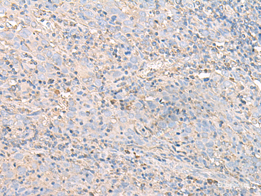 Immunohistochemistry of paraffin-embedded Human cervical cancer tissue  using IGHA1 Polyclonal Antibody at dilution of 1:50(×200)