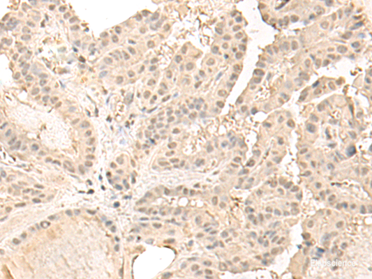 Immunohistochemistry of paraffin-embedded Human thyroid cancer tissue  using ZGPAT Polyclonal Antibody at dilution of 1:35(×200)