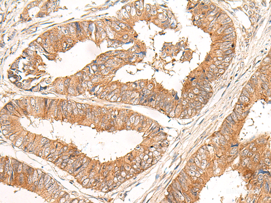 Immunohistochemistry of paraffin-embedded Human colorectal cancer tissue  using CORO2A Polyclonal Antibody at dilution of 1:30(×200)