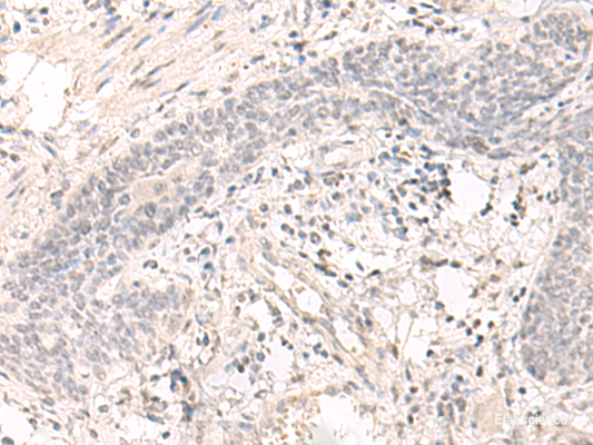 Immunohistochemistry of paraffin-embedded Human esophagus cancer tissue  using SAP130 Polyclonal Antibody at dilution of 1:35(×200)