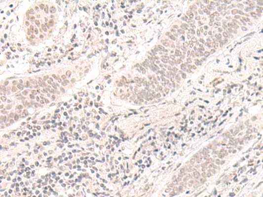 Immunohistochemistry of paraffin-embedded Human esophagus cancer tissue  using ZBED1 Polyclonal Antibody at dilution of 1:40(×200)