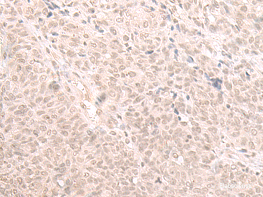 Immunohistochemistry of paraffin-embedded Human ovarian cancer tissue  using HOOK2 Polyclonal Antibody at dilution of 1:30(×200)