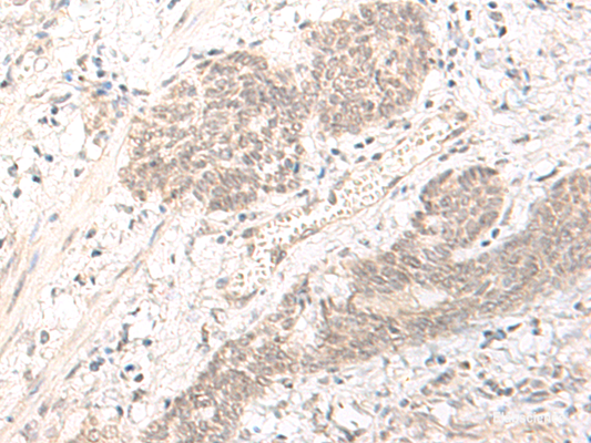Immunohistochemistry of paraffin-embedded Human esophagus cancer tissue  using PBXIP1 Polyclonal Antibody at dilution of 1:40(×200)