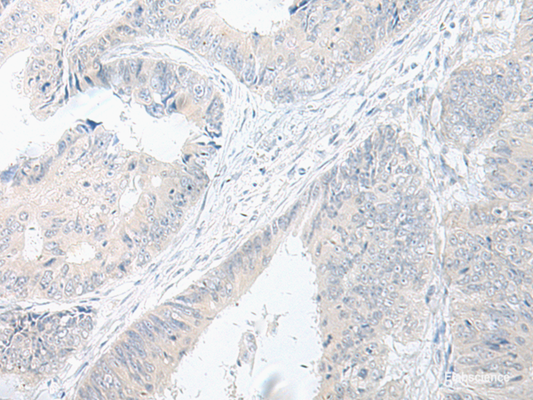 Immunohistochemistry of paraffin-embedded Human colorectal cancer tissue  using GPRASP2 Polyclonal Antibody at dilution of 1:75(×200)