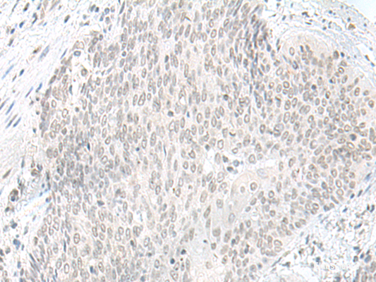 Immunohistochemistry of paraffin-embedded Human esophagus cancer tissue  using ORC1 Polyclonal Antibody at dilution of 1:65(×200)
