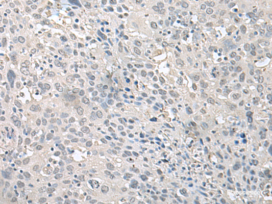 Immunohistochemistry of paraffin-embedded Human cervical cancer tissue  using EPM2A Polyclonal Antibody at dilution of 1:75(×200)